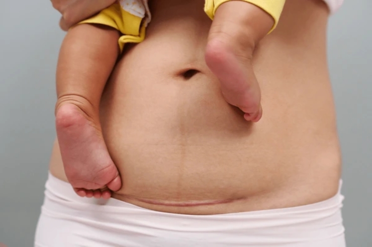 Cesarean Section (C-Section)------12