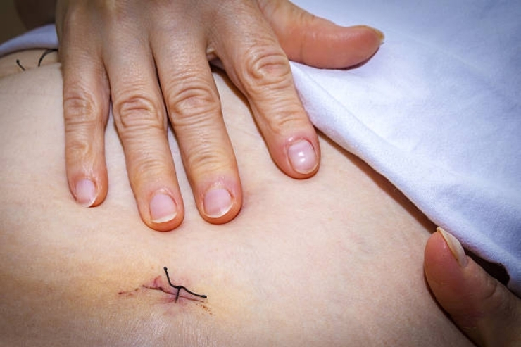 Endometriosis Excision Surgery--------12