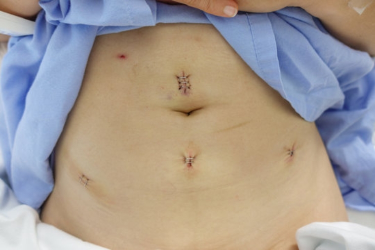 Laparoscopic Myomectomy-------12