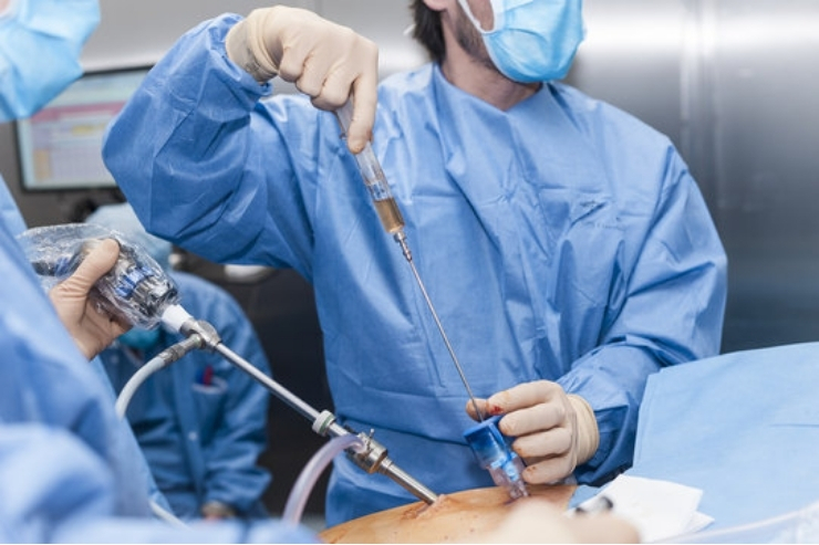 Laparoscopic Ovarian Cystectomy-------12